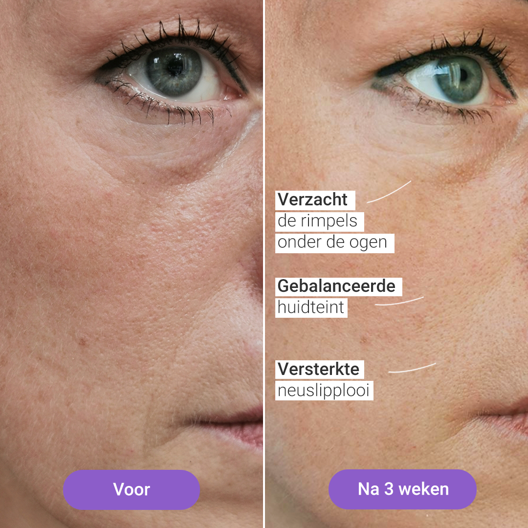 Masque de luminothérapie Lumi